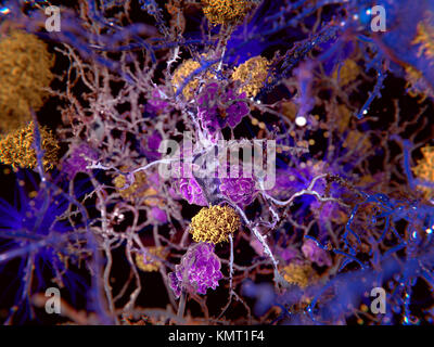 Alzheimer's disease.Computer illustration of amyloid plaques (yellow) amongst neurons.Amyloid  plaques are characteristic features of Alzheimer's disease.They lead to degeneration of the affected neurons,which are destroyed through the activity of microglia cells (violet).