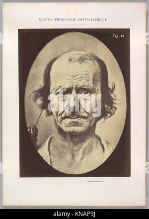 Figure 12- A study of the contraction of and the expression produced by the superior part of m. orbicularis oculi MET DP304494 623032 Stock Photo