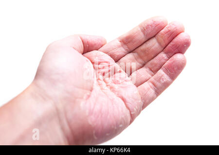 The problem with many people - eczema on hand. Isolated background Stock Photo