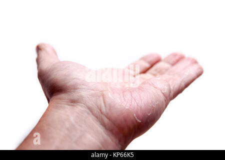 male palms with eczema isolated on white background Stock Photo