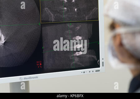 CT scan of lumbar spine 3D rendering showing Profile Human Spine ...