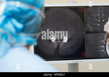 CT scan of lumbar spine 3D rendering showing Profile Human Spine ...