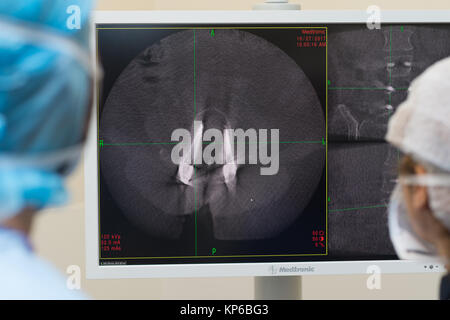 CT scan of lumbar spine 3D rendering showing Profile Human Spine ...