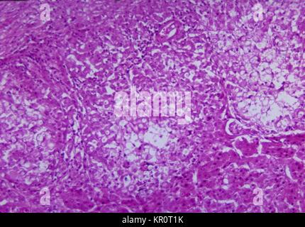 This micrograph depicts histopathologic changes due to cryptococcosis of the adrenal gland, 1964. Cryptococcosis is transmitted through inhalation of airborne yeast cells and/or biospores. At risk are the immunocompromised, especially those with HIV infection. Image courtesy CDC/Dr. Martin Hicklin. Stock Photo