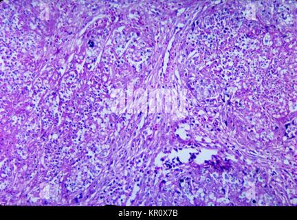 This micrograph depicts the histopathologic changes of the spleen due to Histoplasma duboisii, 1965. Histoplasmosis, due to Histoplasma duboisii, is a mycotic infection primarily involving cutaneous, liver, lung, lymphatic, subcutaneous, and bony tissues. Image courtesy CDC/Dr. Martin Hicklin. Stock Photo