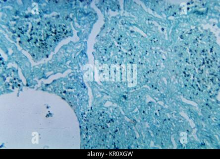 This micrograph depicts histopathologic changes associated with Histoplasmosis of the lung using methenamine silver stain, 1964. Here the yeast forms of H. capsulatum are shown. This organism which grows in soil or material contaminated with bat or bird droppings, becomes airborne when contaminated soil is disturbed, and breathing the spores causes infection. Image courtesy CDC/Dr. Martin Hicklin. Stock Photo