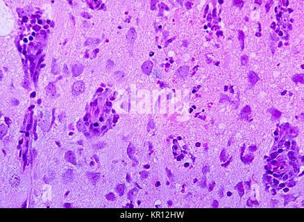 Under a magnification of 300X this photomicrograph reveals the histopathologic changes in a case of encephalitis due to the Tamiami virus, 1972. Tamiami virus has been found to be associated with cotton rats, Sigmodon hispidus . This virus is a member of the Tacaribe complex, a serotype of the genus Arenavirus, or ?. New world arenaviruses? . Image courtesy CDC/Dr. W. Winn. Stock Photo