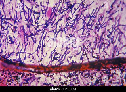 This photomicrograph reveals histopathologic changes indicative of endocarditis caused by the fungus Candida albicans, 1963. In severely immunocompromised patients, Candida can cause inflammation of the endocardium, or endocarditis, which more often involves a heart valve. Untreated, this infection can 'eat away' at, and damage the heart valve, causing malfunction. Image courtesy CDC/Sherry Brinkman. Stock Photo