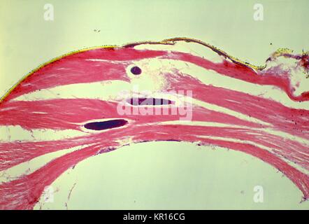 A photomicrograph revealing the histology of Onchocerca volvulus developing in a Black Fly, Simulium ochraceum, 1978. O. volvulus, the filarial parasite responsible for causing Onchocerciasis, River Blindness, is transmitted to its human host through the bite of Simulium spp. flies such as the Black Fly. Image courtesy CDC/Dr. R.C. Collins. Stock Photo