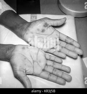 A patient with papulosquamous syphilids, or cutaneous eruptions of the disease, seen here on the wrist and palms. This patient presented with papulosquamous syphilids on the wrist and palms during the secondary stage of syphilis, 1971. The rash often appears as rough, red or reddish brown spots and can appear on both the palms of the hands and on the bottoms of the feet. Image courtesy CDC/Susan Lindsley. Stock Photo