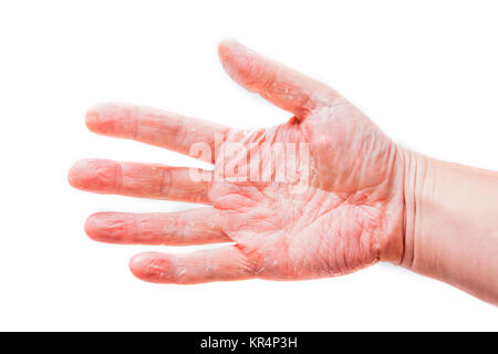 The problem with many people - eczema on hand. Isolated background Stock Photo