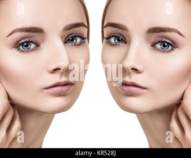 Female nose before and after cosmetic surgery. Stock Photo