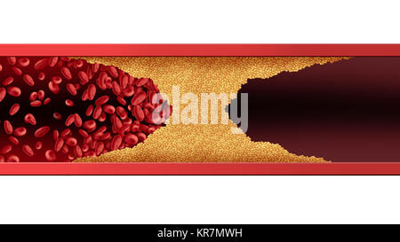 Blocked blood vessel human artery disease with cholesterol buildup clogging or blocking circulation flow with 3D illustration elements. Stock Photo