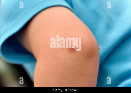 Toddler boys elbow showing dissolvable stitches after keyhole surgery Stock Photo