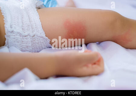 Leg of sleeping Small child with redness on the skin, suffering from food allergies,  Baby's leg covered by eczema. allergy baby skin dermatitis food. Stock Photo