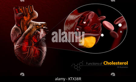 Heart as example, Blocked blood vessel, artery with cholesterol buildup ...