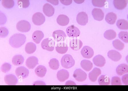 Photomicrograph of a blood smear showing Plasmodium falciparum rings inside erythrocytes. The term 'ring' is derived from the morphologic appearance of this stage, which includes chromatin (red), cytoplasm (blue), often arranged in a ring-shape around a central vacuole, biologically, the ring is a young trophozoite. Image courtesy CDC/Dr. Mae Melvin, 1971. Stock Photo