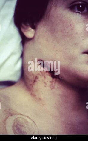 Plague patient whose symptoms include this swollen, ulcerated cervical lymph node. After the incubation period of 2-6 days, symptoms of the plague appear including severe malaise, headache, shaking chills, fever, and pain and swelling, or adenopathy, in the affected regional lymph nodes, also known as buboes. Image courtesy CDC, 1993. Stock Photo