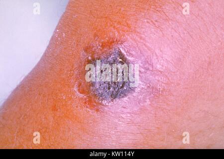 Anthrax skin lesion Stock Photo - Alamy