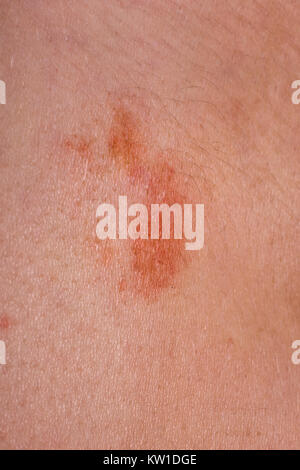 The great red spot on the skin closeup. Stock Photo
