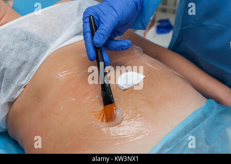 A woman undergoes the Carboxytherapy procedure on her stomach in a beauty salon. The doctor brushes a cream with oxygen CO2 Stock Photo