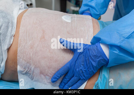 A woman undergoes the Carboxytherapy procedure on her stomach in a beauty salon. The doctor applies special paper sheets The procedure is based on oxy Stock Photo