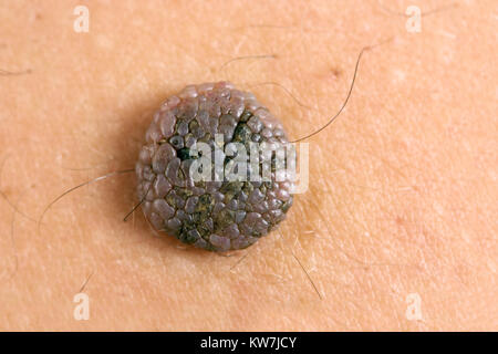 Ultra high resolution close up photo of a mole on the skin Stock Photo