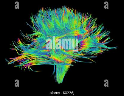 White matter fibres. Computer enhanced 3D diffusion spectral imaging (DSI) scan of the bundles of white matter nerve fibres in the brain. The fibres transmit nerve signals between brain regions and between the brain and the spinal cord. Diffusion spectrum imaging (DSI) is a variant of magnetic resonance imaging (MRI) in which a magnetic field maps the water contained in neuron fibers, thus mapping their criss-crossing patterns. A similar technique called diffusion tensor imaging (DTI) is also used to explore neural data of white matter fibres in the brain. Both methods allow mapping of their Stock Photo