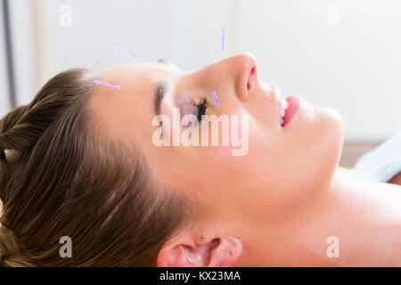 Woman at acupuncture with needles in face Stock Photo