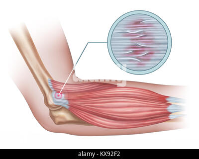 Tennis elbow diagram showing a detail of the damaged tendon tissue. Digital illustration. Stock Photo
