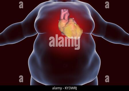 Computer illustration of a fatty heart in an overweight man. Stock Photo