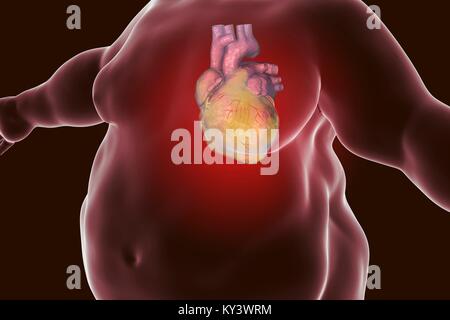 Computer illustration of a fatty heart in an overweight man. Stock Photo