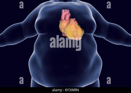 Obese man's heart, computer illustration. Stock Photo