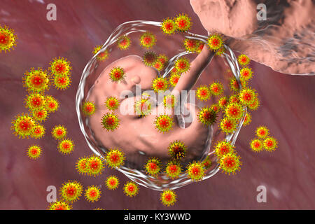 Human immunodeficiency viruses (HIV) infecting human embryo, conceptual illustration. The embryo is 4 weeks old. Stock Photo