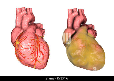 Healthy heart (left) and heart with left ventricular hypertrophy and fat layer (right), computer illustration. Stock Photo