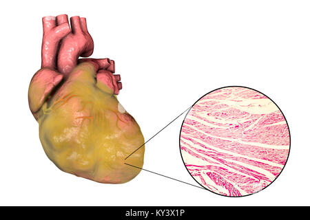 Illustration of a fatty heart with left ventricular hypertrophy and light micrograph of hypertrophic cardiac tissue. Stock Photo