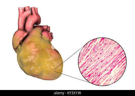 Illustration of a fatty heart with left ventricular hypertrophy and light micrograph of hypertrophic cardiac tissue. Stock Photo