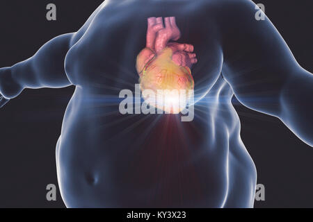 Heart attack in obese man, computer illustration. Stock Photo