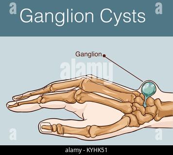 vector illustration of a Ganglion cyst Stock Vector Image &amp; Art - Alamy