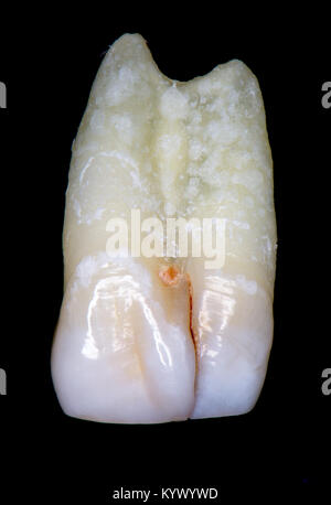 tooth fusion or gemination or concrescence Stock Photo - Alamy