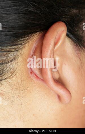 wound behind ear Stock Photo - Alamy