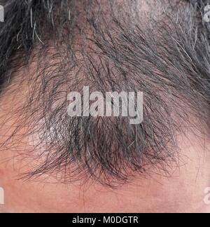 Point of focus lose one's hair glabrous baldy loss hairline men. Stock Photo