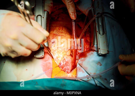 Human heart during cardiac surgery transplantation. Surgeon view chest during heart surgery surgical instruments close-up Stock Photo
