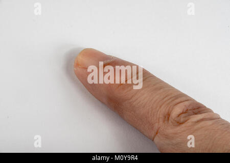 Ganglion Cysts growing on a finger Stock Photo - Alamy