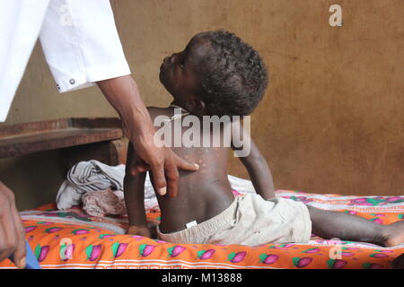 Marana, Madagascar. 23rd Jan, 2018. The two year old Tabidi, daughter of leper Le Zafy, is being examined for the possibility of leprosy in Marana, Madagascar, 23 January 2018. Despite of the spots on her skin, it is still unclear if the girl suffers from leprosy as well. She lives with her father in the leprosy centre in Marana, which is located approximately 9 hours by car away from the Madagascan capital Antananarivo. Credit: Laetitia Bezain/dpa/Alamy Live News Stock Photo