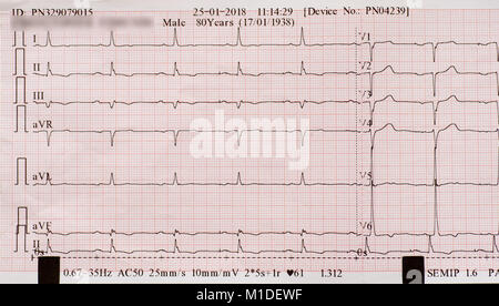 ECG printout for 80 year old male heart patient. Stock Photo