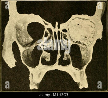 A text-book of diseases of the nose and throat (1907) (14765503692) Stock Photo