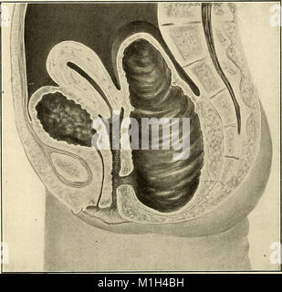 American practice of surgery; a complete system of the science and art of surgery (1906) (14740641626) Stock Photo