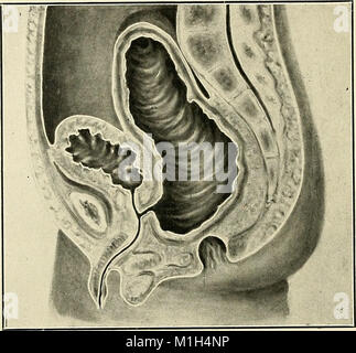 American practice of surgery; a complete system of the science and art of surgery (1906) (14760467561) Stock Photo