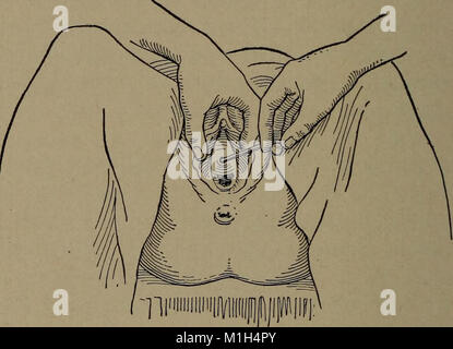 A reference hand-book of gynecology for nurses (1913) (14773031391) Stock Photo